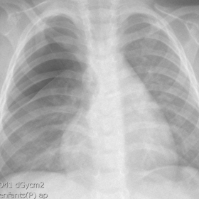 Chest X-ray