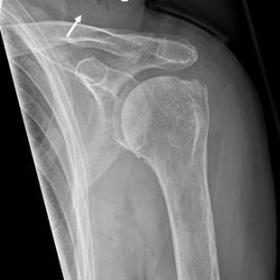 Antero-posterior radiograph of the left shoulder