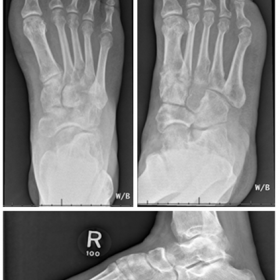 X-ray right foot (AP/oblique /lateral ) views