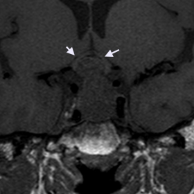 Coronal T1WI, sagittal T1WI and axial T2WI