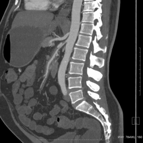 Sagittal reformatted CT image