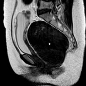 Pelvic MRI - T2-weighted multiplanar images