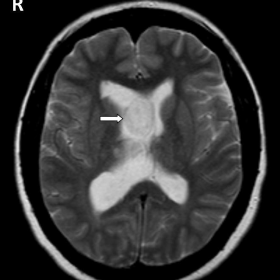 MRI, Axial T2-weighted image