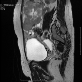 Sagittal T2W MRI