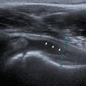 Ultrasound of the right hip