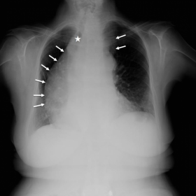 Posterior-anterior chest radiograph