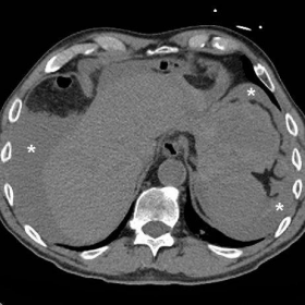 Emergency multidetector CT after EUS-guided biopsy