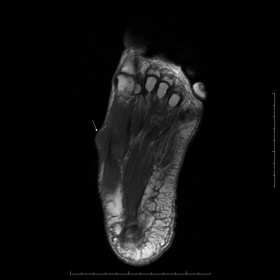 Coronal T1W MRI image of the foot