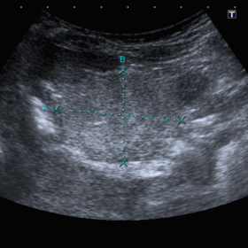 Ultrasound of the abdomen