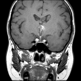 Coronal T1-weighted MRI