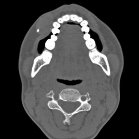 Bone window of axial CT image