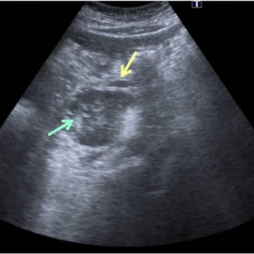 Pancreatic mass - ultrasound