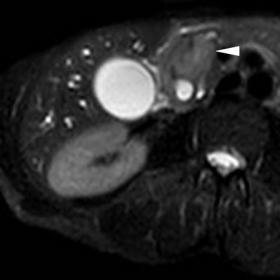 Preoperative studies: MRI + Plastic biliary stent