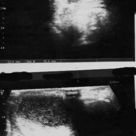 High-resolution ultrasound
