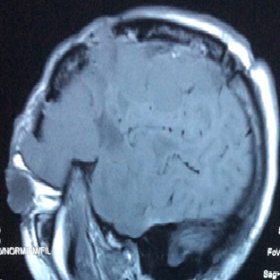 Pre-contrast sagittal T1-weighted MRI