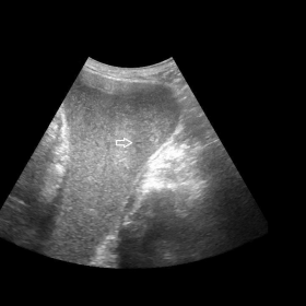 Ultrasound of the right gluteal region