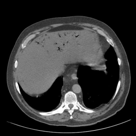 Axial non-contrast CT image through the liver