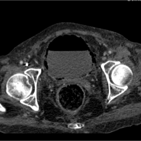Axial non-contrast-enhanced CT of the pelvis