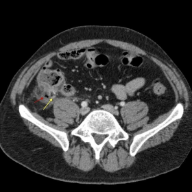 Intravenous contrast-enhanced computed tomography (CT) of the abdomen
