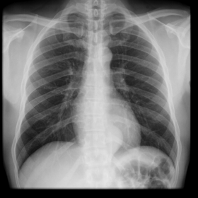 Posteroanterior chest X-ray