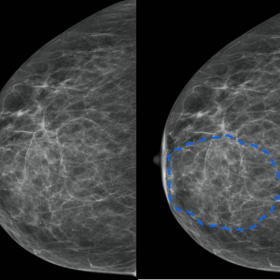 Mammography craniocaudad of the right breast.