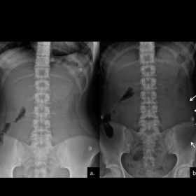 X-ray of the abdomen