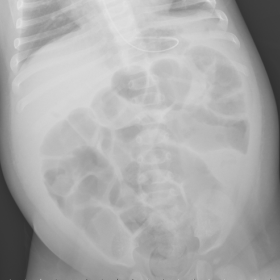 An unusual cause of abdominal pain in an infant