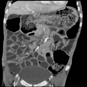 Contrast enhanced CT coronal images of the abdomen.