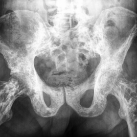 Plain X-ray of the pelvis