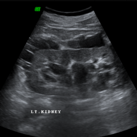 Ultrasound left kidney