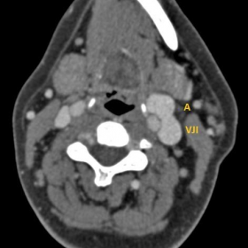 Cross-sectional CT image demonstrating aneurysm of left IJV