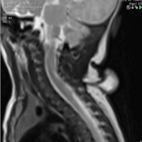 T2-weighted sagittal MR
