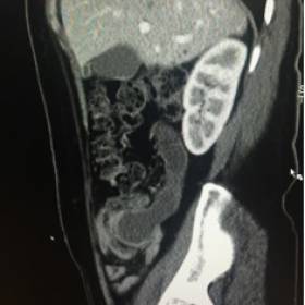 Abdominal CT sagittal reconstruction