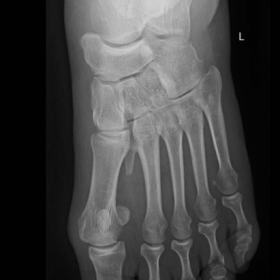 Foot AP X-ray projection