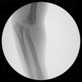 Left elbow intraoperative (oblique view)
