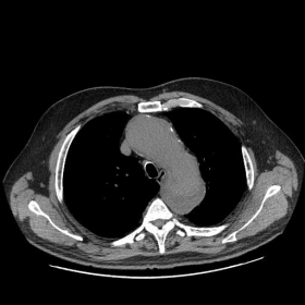 Thoracic CT