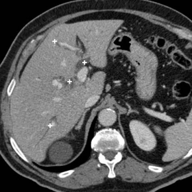 Preoperative contrast-enhanced multidetector CT study