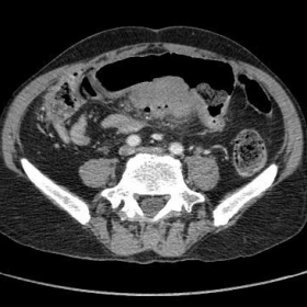 Axial post contrast CT image of the abdomen