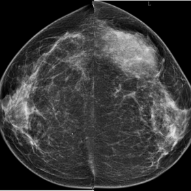 Bilateral CC mammograms