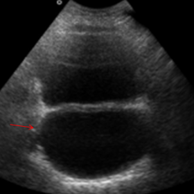 Transabdominal pelvic ultrasound: transverse view