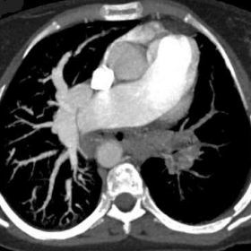 Axial CT pulmonary angiography