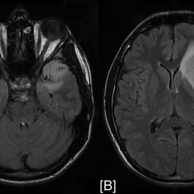 Preoperative MRI FLAIR images