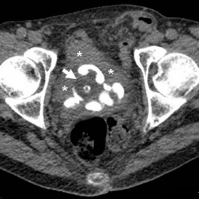 (Four months earlier) unenhanced and post-contast multidetector CT