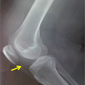 Radiograph of the right knee