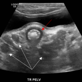 Transverse ultrasound