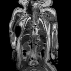 MRI, whole body coronal FIESTA sequence