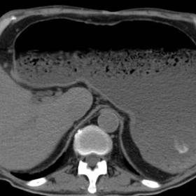 Urgent unenhanced and post-contrast multidetector CT