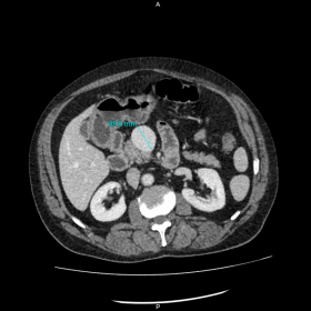 Cross sectional CT image showing aneurysm of SMV