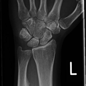 Left forearm radiograph
