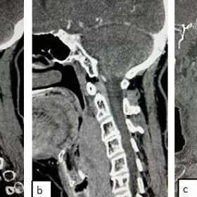 Retropharyngeal desmoid tumour: CT findings